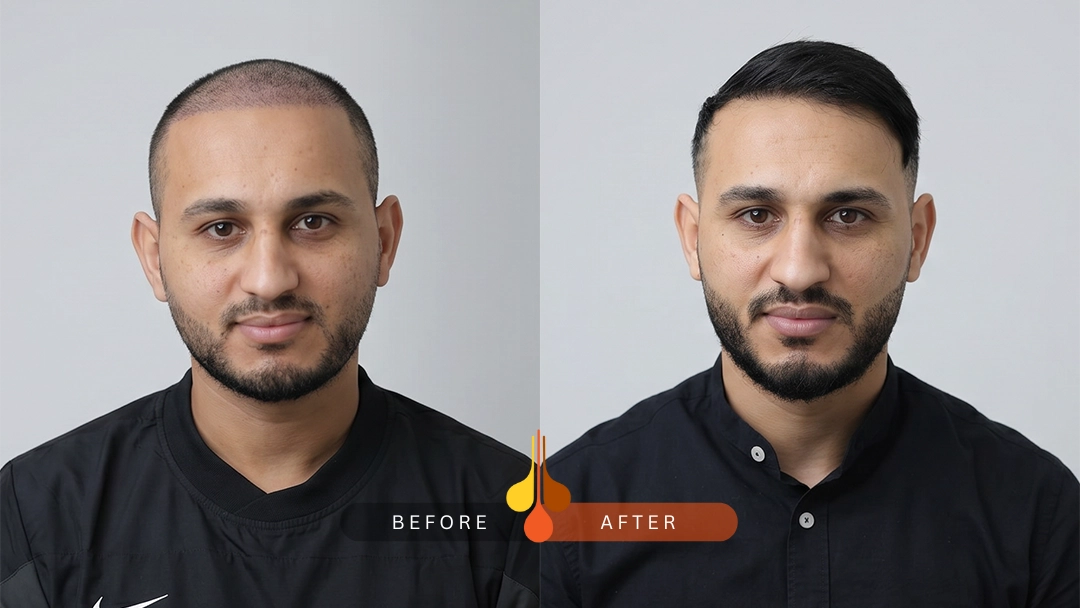 Before and after frontal hair transplant results in Padra Clinic, Qatar
