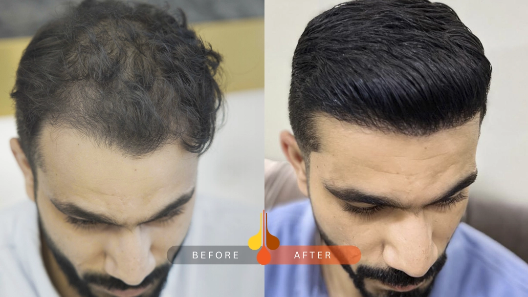 Successful FUE hair transplant before and after in Riyadh