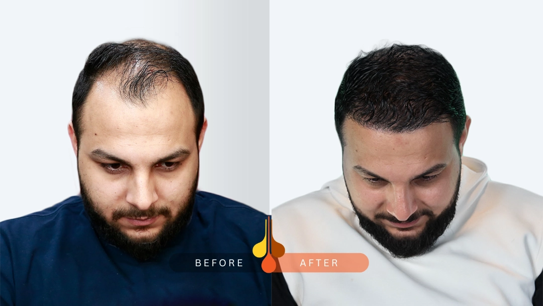 result of hair transplant in Riyadh